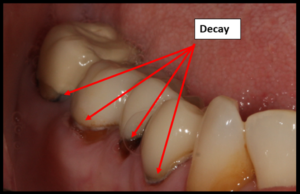 root canal crown
