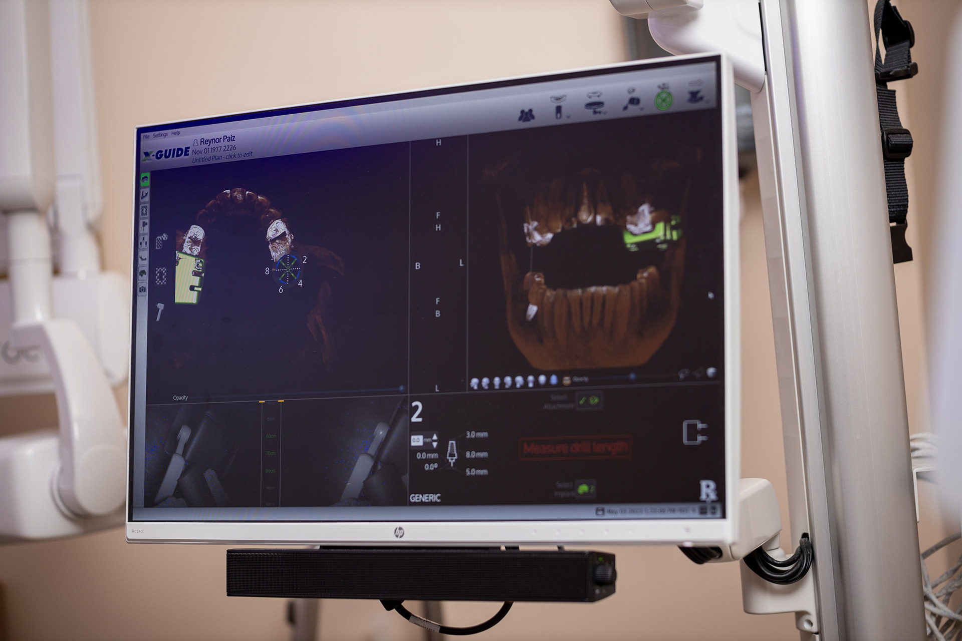 Guided implant navigation system used for precise dental implant placement Guided implant navigation system used for precise dental implant placement